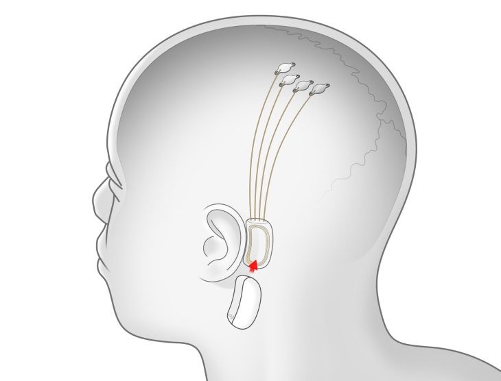 Un dessin representant une puce introduite dans un cerveau humain (Neuralink).